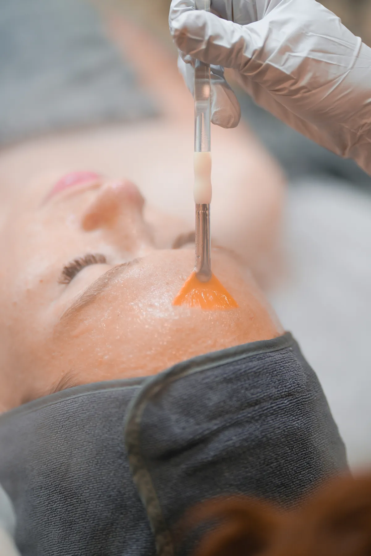 Chemical Peel